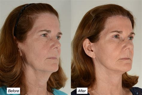 Facelift Doctor In Charleston Charleston Facial Plastic Surgery