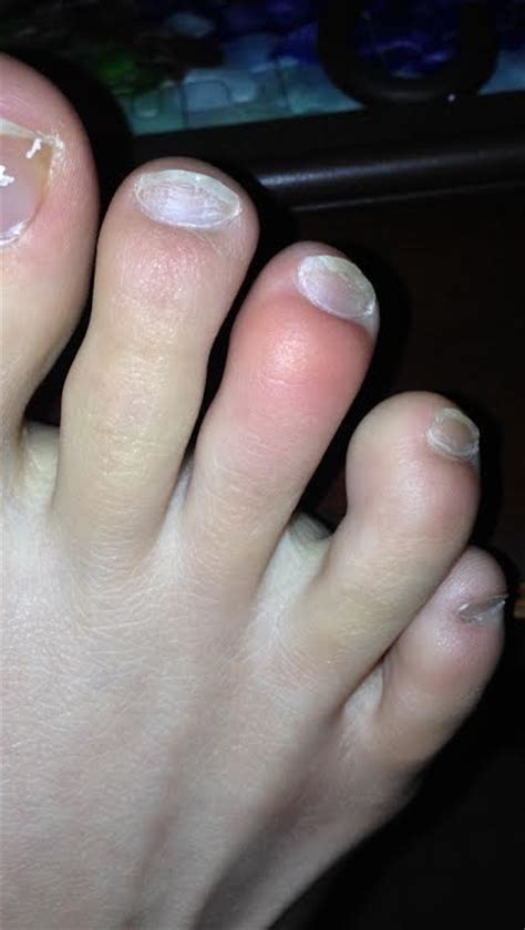 Itchy Bump On Toe Pictures Photos