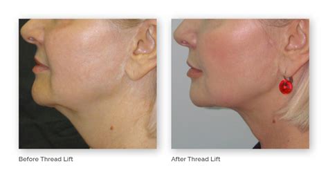 Facial Thread Lifts Prèface Cosmetic Newcastle And Maitland