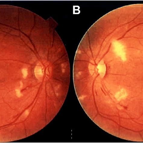 Fundus Photographs Of The Right Eye A And The Left Eye B From The