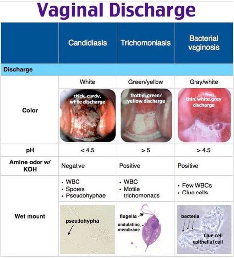 Vaginal Discharge Medizzy