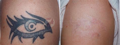 Laser Pigment And Tattoo Removal Before And After Pictures Case 30