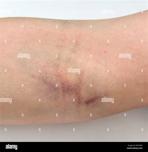 Bruising Hi Res Stock Photography And Images Alamy