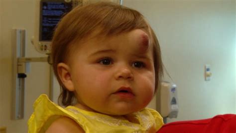 Baby With Disfiguring Growth Saved With Miracle Surgery