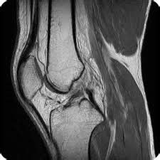 See the pictures and anatomy description of knee joint bones, cartilage, ligaments, muscle and tendons with resources for knee problems & injuries. knee anatomy mri - DriverLayer Search Engine