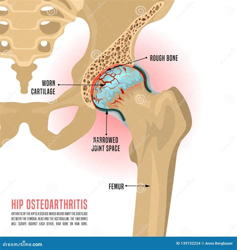 Hip Osteoarthritis Infographic Stock Vector Illustration Of Health