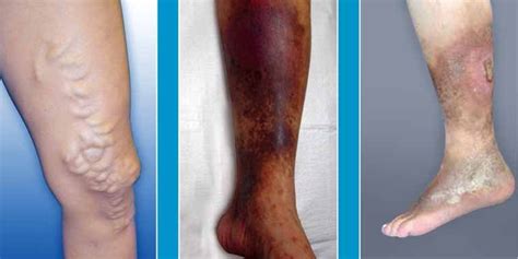 Risk Factors Of Varicose Veins Varicose Veins And Wound Clinic Vasai