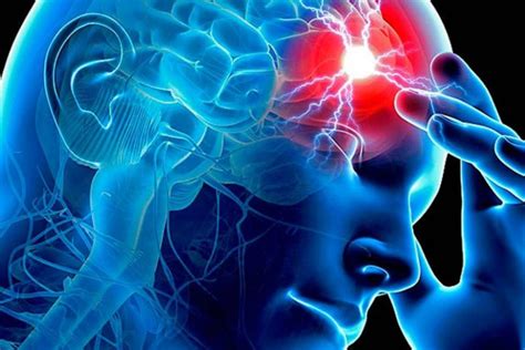 Accidente cerebrovascular ictus tipos causas síntomas y tratamiento