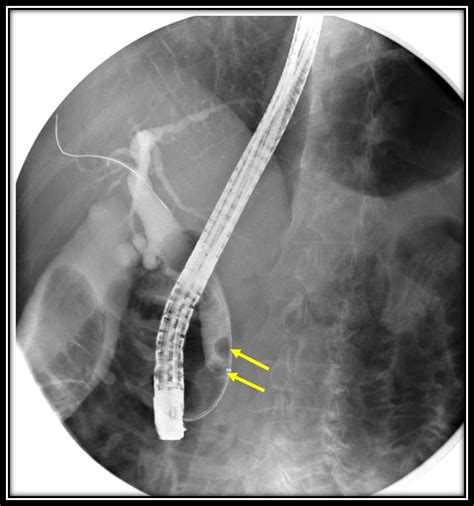 Endoscopic Removal Of Choledocholithiasis Radiology Cases