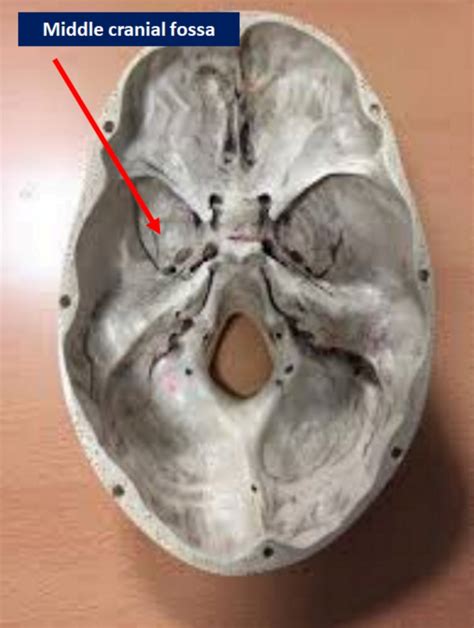 Figure Middle Cranial Fossa Contributed By Bruno Bordoni Phd