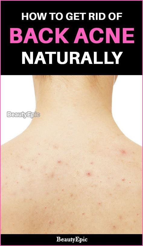 Acne And Acne Remedies All Natural Means To Eliminate And Also Avoid