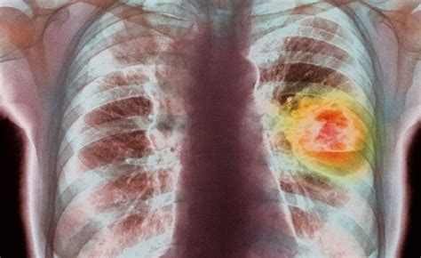 Mengenal Dua Macam Kanker Paru Salah Satunya Efek Samping Merokok