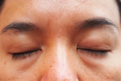 Common Types Of Eye Bags And How To Remove Them Dream Plastic Surgery