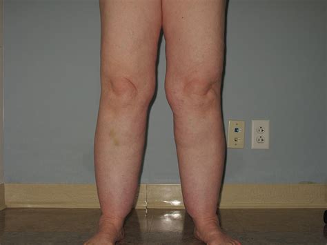 Lipedema Timing1