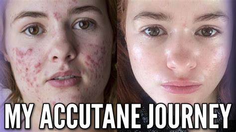 My Accutane Journey With Progress Photos And Relapse Experience YouTube