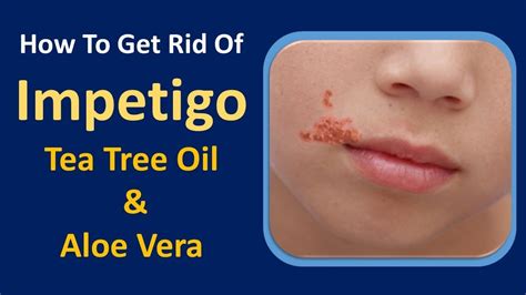 How To Get Rid Of Impetigo Tea Tree Oil And Aloe Vera Home Remedy Youtube