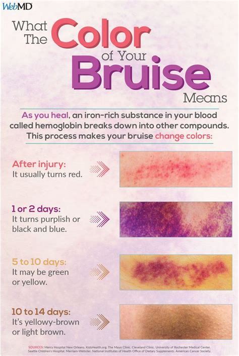 Anatomy Of A Bruise Artofit
