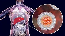 Tudo o que você precisa saber sobre Hepatites Virais - Pronep Life Care