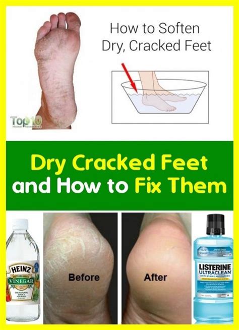 Dry Cracked Feet And How To Fix It In 2020 Dry Cracked Feet Cracked