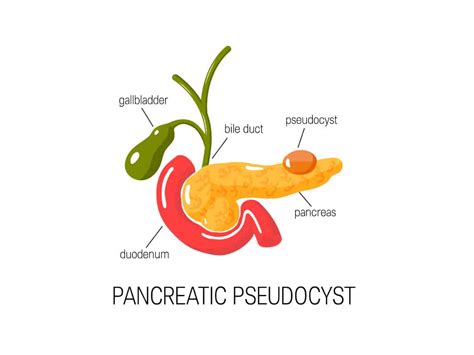 Pancreatic Cysts Gastroenterologist Gastroscopy Endoscopy
