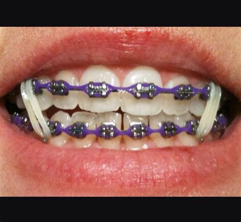 How Do Rubber Bands On Braces Help Marisol Edgar
