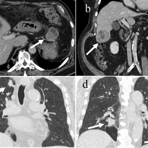 Thoracic And Abdominal Ct Imaging Of Recurrent Tumors A Abdominal Ct