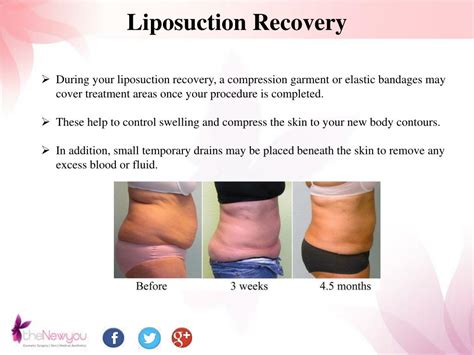 The same goes for some. PPT - Liposuction Fat Removal Surgery for Men and Women. PowerPoint Presentation - ID:7172176