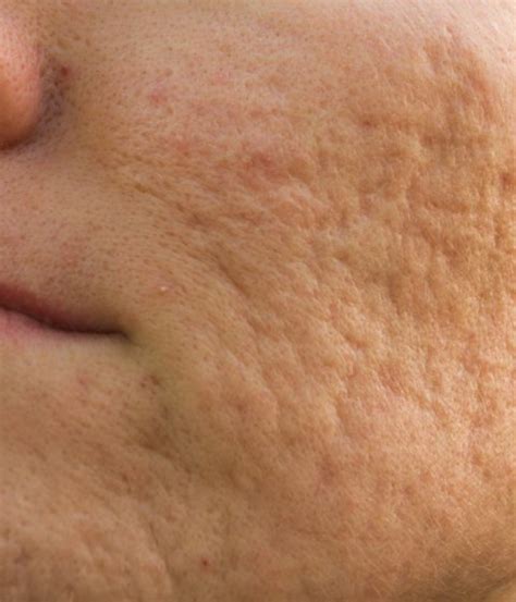 7 Tips To Improve Acne Scars Dr Kally Papantoniou
