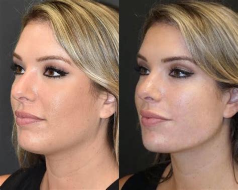 Pdo Jawline Jowl Thread Lift In Clearwater Florida