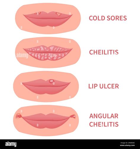Cold Sore Lips Stock Vector Images Alamy