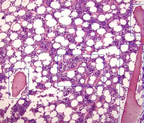 The marrow may also contain abnormal cells, proteins, or inflammatory reactions that are not normally present, such as cancer cells (for example, hodgkin or. Jestem patologiem i dzisiaj opowiem wam dla odmiany o ...