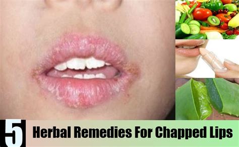 Top 5 Herbal Remedies For Chapped Lips Natural Home Remedies
