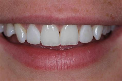 Before And After Dental Bonding Photos Cosmetic Bonding Dentists