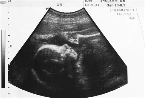 Ultrasound Photo Of Unborn Baby In Mother S Womb Stock Photo Image Of