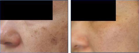 Laser Age Spot Removal Before And After Using Creams To Obscure Brown