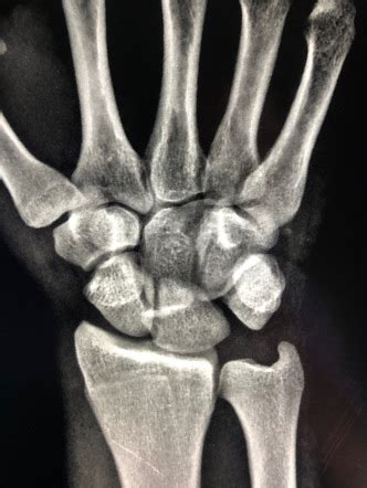 Perilunate Dislocation Radiology Reference Article Radiopaedia Org