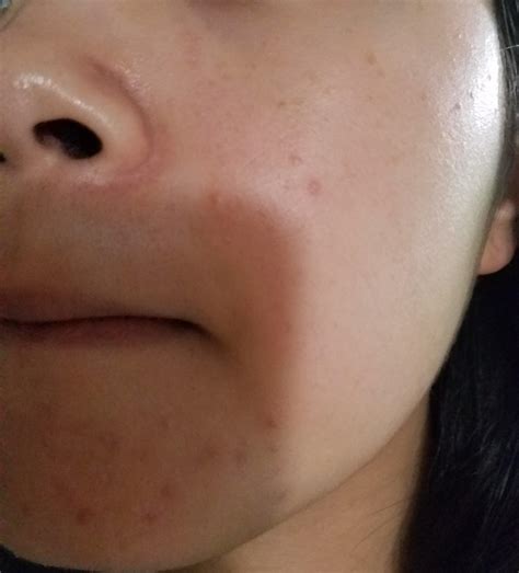 What Are These Bumps And How To Treat Skin Concerns Skincareaddiction