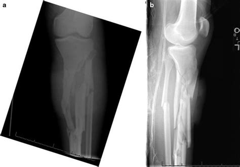 Shortening Of Leg Due To Fracture