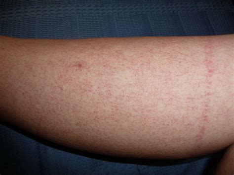 Reddish Rash On Arm Pictures Photos