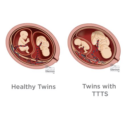 Twin To Twin Transfusion Syndrome Ttts Stages And Diagnosis Ssm Health