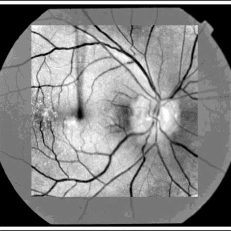 Fundus Photographs Showing Optic Disc Drusen In Both Eyes And Disc
