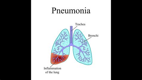 Pneumonia Podcast By Jay Harold Youtube