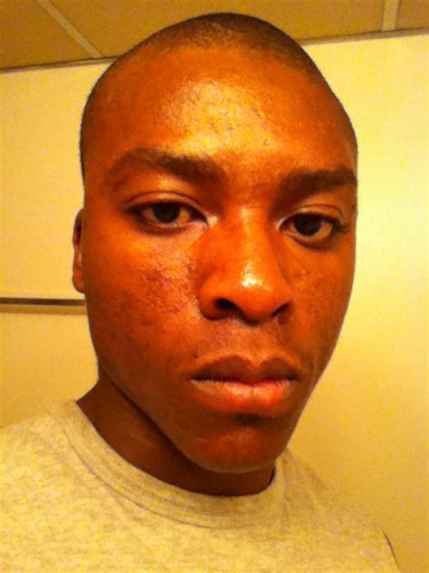 Please Tell Me If Am Ugly Severe Acne Scars General Acne Discussion