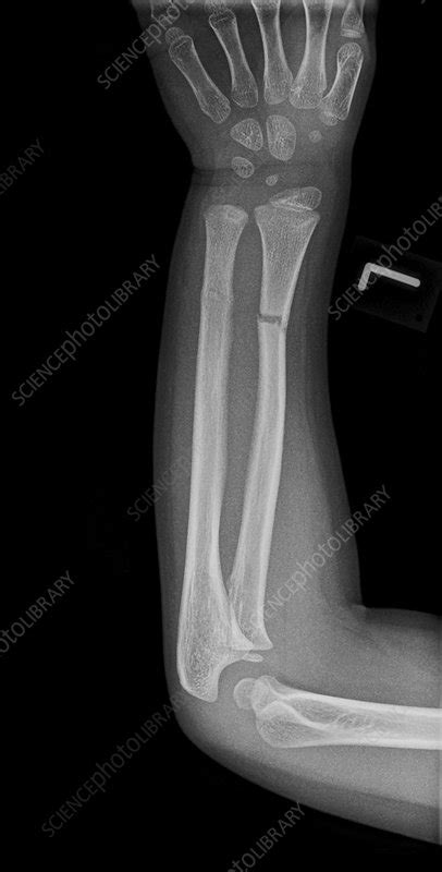 Broken Arm X Ray Stock Image C0177264 Science Photo Library