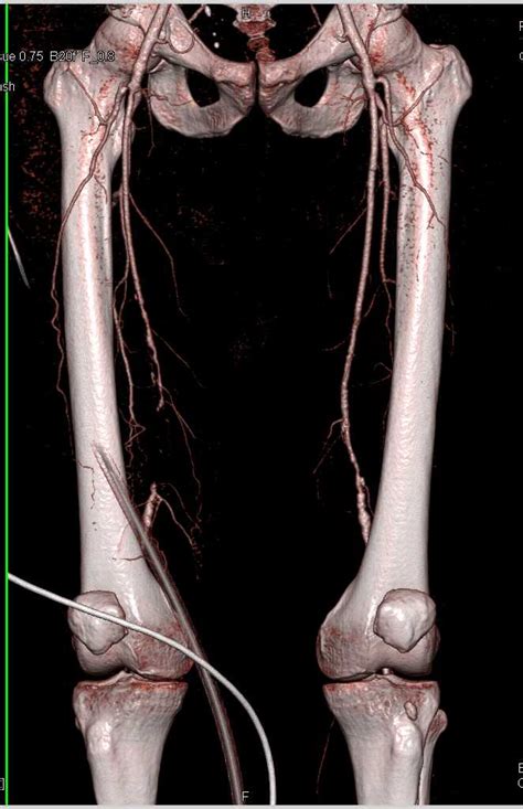 Superficial Femoral Artery Sfa Occlusion With Severe Peripheral