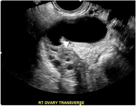 Isolated Fallopian Tubal Torsion A Challenging Ultrasound Diagnosis