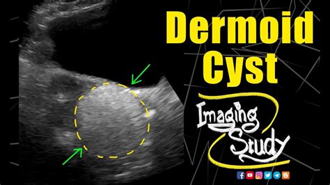 Dermoid Cyst Ultrasound Case 164 Youtube