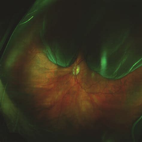 Use Of Optomap For Retinal Screening Within An Eye Casualty Setting