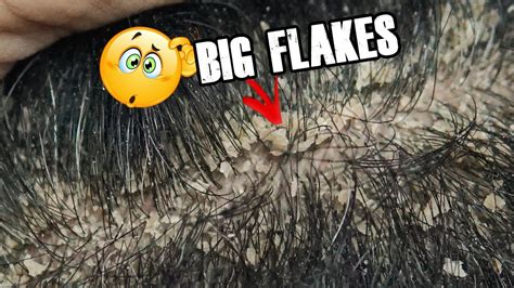 Itchy Scalp Flakes Dandruff Scratching Big Flakes Satisfying Youtube