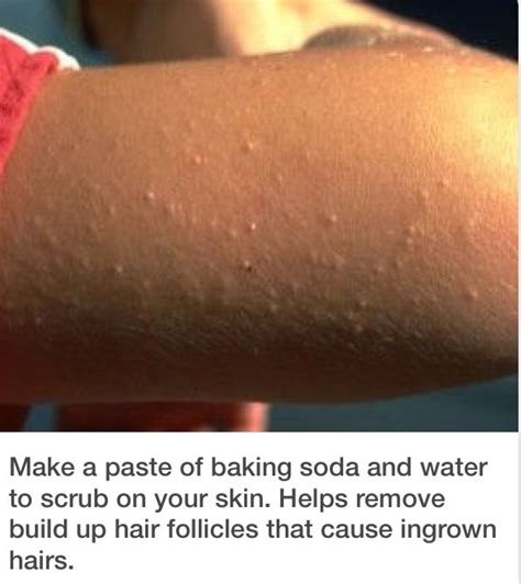 Get Rid Of Those Bumps On Your Arms And Legs Body Skin Care Skin